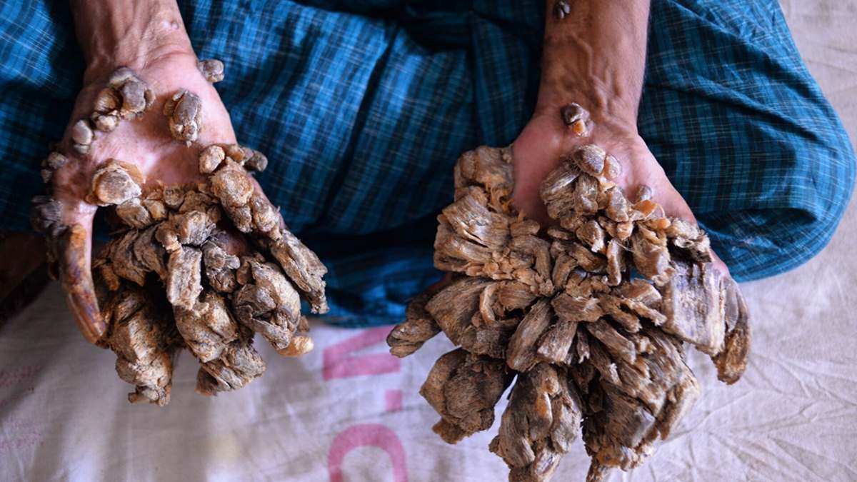 بیماری مرد درختی