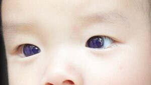 تغییر رنگ چشم یک نوزاد بعد از مصرف داروی کرونا